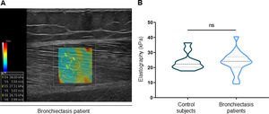 (A) Longitudinal sagittal plane SWE ultrasound image. The image shows a color box in the muscle zone. Adjacent ROIs were used to measure tissue elasticity. Note that the elasticity is expressed in kPa and in speed (m/s). (B) Violin plots with median (dashed line), first and third quartiles (dotted lines) and maximum and minimum values of VL elastography in control subjects and bronchiectasis patients. Definition of abbreviations: SWE, shear wave elastography; ROIs, regions of interest; kPa, kilopascal; m/s, meters per second; VL, vastus lateralis; ns, not significant.