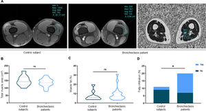 (A) Left and middle panel: Axial plane MRIs using a selective adipose tissue saturation sequence (Axial T1 Fat Sat) in a control subject and a bronchiectasis patient. Muscle area was measured with a blue ROI. Left panel shows normal muscle volume. Middle panel shows reduced muscle volume (hypotrophy). Right panel: Axial plane MRI of the distal VL muscle using a non-contrast Axial 3D IDEAL fat fraction with IDEAL-reconstructed sequence of a bronchiectasis patient. Measurement of muscle fat fraction percentage was performed using a single ROI focused on the distal lateral vastus muscle (blue circle). Note that the data is expressed as a single average (“Avg” in the side table next to the ROI). In this case, an average of 11 represents a 11% of the adipose content confirming normal muscle trophism. (B and C) Violin plots with median (dashed line), first and third quartiles (dotted lines) and maximum and minimum values of total muscle area and thigh fat percentage of the quadriceps measured by magnetic resonance imaging (MRI) in control subjects and bronchiectasis patients. (D) Stacked bar chart showing the lack or presence of macroscopic fatty infiltration in control subjects and bronchiectasis patients measured by MRI. Definition of abbreviations: MRI, magnetic resonance imaging; ROI, region of interest; VL, vastus lateralis; N, number; ns, not significant. Statistical significance: *p<0.05.