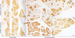 Representative images of VL cross-sectional histological preparations. Myofibers positively stained for slow-twitch antibody appear in brown color in upper panels. Myofibers positively stained for fast-twitch antibody appear in brown color in lower panels. Hybrid myofibers are positively stained for both slow-twitch and fast-twitch antibodies (black arrows). Scale bar=100μm. Definition of abbreviations: VL, vastus lateralis; μm, micrometer.