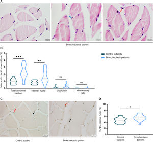 (A) Representative images of muscle structural abnormalities in the VL: internal nuclei (black arrow), lipofuscin (blue arrow) and inflammatory cell (red arrow). Scale bar=20μm, 40× magnification. (B) Violin plots with median (dashed line), first and third quartiles (dotted lines) and maximum and minimum values of muscle abnormalities as measured by total abnormal fraction and proportions of internal nuclei, lipofuscin and inflammatory cells identified in the VL of control subjects and bronchiectasis patients. Statistical significance: **p≤0.01, ***p≤0.001. (C) Representative images of TUNEL-positively stained nuclei (red arrows) and TUNEL-negative nuclei (black arrows) in the VL. Scale bar=20μm, 40× magnification. (D) Violin plots with median (dashed line), first and third quartile (dotted lines) and maximum and minimum values of the percentage of positively stained nuclei for the TUNEL assay in the VL of the control subjects and bronchiectasis patients. Statistical significance: *p≤0.05. Definition of abbreviations: VL, vastus lateralis; μm, micrometer; TUNEL, terminal deoxynucleotidyl transferase-mediated dUTP nick-end labeling; ns, not significant.