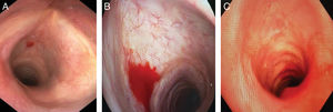 Internal signs in the larynx produced by puncture of the cricothyroid membrane. (A) Puncture site, (B) slight bleeding, and (C) moderate bleeding.