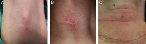 External cutaneous signs produced by puncture of the cricothyroid membrane. (A) Puncture site, (B) erythema, and (C) haematoma.