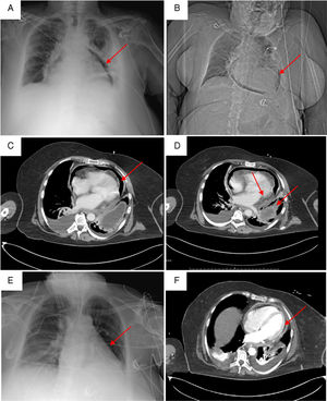 Clinical case images. (A) Chest X-ray showed air around of pericardial sac (red arrow). (B and C) Chest CT with pneumopericardium (red arrow). (C) Chest CT showed a big hiatal hernia and pneumopericardium secondary to gastropericardial fistula (red arrow). (D and E) Decreased pneumopericardium after surgical intervention (red arrow).