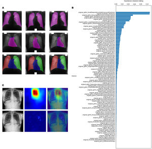 CXR segmentation and post-COVID-specific radiomic features. (A) Machine learning-based algorithm accurately identifies the lungs, the heart, and the background and calculates the CTR. (B) Radiomic features distinguishing post-COVID patients from COVID-19 and non-COVID individuals. (C) Visualization of representative post-COVID-specific areas on CXRs. CTR: cardiothoracic ratio; CXR: chest X-ray.