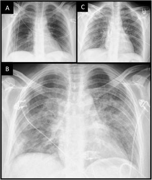 (A) Chest X-ray upon admission with normal characteristics. (B) Chest X-ray after admission to IUC at 24h with alveolar pattern suggestive of acute lung edema. (C) Chest X-ray at 72h with resolution of the acute lung edema pattern.