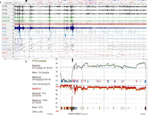 (a) A 5-minute epoch nocturnal polysomnography (Somnoscreen Plus (Somnomedics-Germany)). The black box above the upper hypnogram shows the sleep stage the patient is in. The side bracket marks the respiratory sensors (nasal airflow via thermistor, respiratory effort signals (thoracic, abdominal and RIP sum belts), and oxygen saturation). At the beginning a completely irregular breathing pattern can be observed while the patient is awake. As the sleep begins, in the first half of the epoch we can see episodes of prolonged absence of flow with no respiratory effort throughout the events (central apnea), lasting up to 76s, followed by a decrease in oxygen saturation up to 72%. The record shows a stable and regular pattern at the end of the epoch, which continues until the end of the night. (b) Summary recording of transcutaneous pCO2 (Sentec Digital Monitoring System, Switzerland) and oxygen saturation throughout the night. On the left side, the overall values for the night are shown; the right side shows the graphic record. Lower black arrows show the onset of sleep (23:45:27). Before that moment, the pCO2 values, as shown by the curve, are greatly decreased (22mmHg). As sleep begins these values increase progressively (coinciding with the prolonged central apnea shown in Fig. 1) and once normal values are reached (35mmHg), breathing is resumed and both CO2 and oxygen saturation remain normal, until the end of the night.