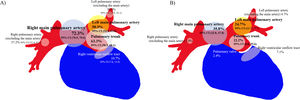 Distribution of primary lesion of primary pulmonary artery sarcoma. (A) CT lesions at initial examination. In the analysis of 384 cases, lesions were more commonly found in the right main pulmonary artery than in the left, with a significant difference (p=0.04). (B) Presumptive primary lesion of PPAS. In the analysis of 170 cases with confirmed primary lesions, the right main pulmonary artery was the most common site. However, no significant difference was observed (p=0.22). CI, confidence interval.