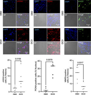 Immunofluorescence staining of γH2AX, PCNA, and MMP9 in DCD and DBD lungs. Representative immunofluorescence staining of γH2AX, PCNA, and MMP9 in DCD and DBD lungs, and number of γH2AX, PCNA, and MMP9 positive cells in DCD and DBD lungs. Data and bars are expressed as plots and medians (n=5).