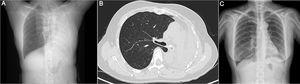 (A) Chest X-ray shows atelectasis of the left lung. (B) CT scan of chest performed on admission reveals irregular thickening of the wall of LMB with extensive calcifications and severe stenosis of the LMB. (C) Chest X-ray 1 day post-operative shows recruitment of the left lung.