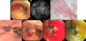 (A) Bronchoscopic visualization shows roughness, micronodular and friable appearance of tracheal mucosa. (B) Bronchoscopic pCLE imaging demonstrates a patchy “cotton wool”-like appearance. (C) Viewing this tissue with polarized light after Congo red staining demonstrates apple-green birefringence. Correlation of bronchoscopic (D) and virtual bronchoscopic views (E) reveals the speculative site of LMB ostium based on experience (green arrow) and the actual site by VBN (yellow dot). (F) Fresh blood is observed in the LMB during bronchoscopic recanalization. (G) The bleeding point is observed as deep yellow (red arrow) compared to surrounding blood, and that allows us to recognize it precisely after switching to RDI mode.