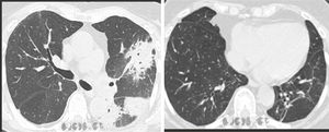 Airspace consolidations, bronchial thickening and bronchial dilatations (left). Eight months later showed total regression of pulmonary densities with some reticular lines and bronchial dilatations in the left lower lobe (right).