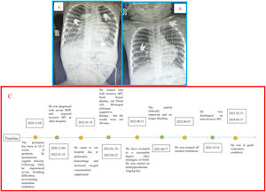 (A) The chest radiograph at the initial presentation showed extensive consolidation in both lungs. (B) The chest radiograph showed multiple mesh shadows in both lungs. (C) The timeline of the patient