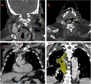 Cervicothoracic CT scan demonstrating: (A) subcutaneous emphysema with air bubbles in the left laterocervical region (green asterisk); (B) cervical abscess accompanied by extensive thrombosis of the left internal jugular vein and ipsilateral dural venous sinuses (green asterisk); (C) severe airway deviation with a minimum glottic lumen diameter of 5mm (red asterisk); and (D) cervical collection with mediastinal extension (highlighted in yellow), responsible for right-sided mediastinitis and significant airway compromise.