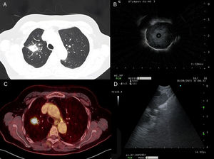 (A) Chest CT with a 31mm spiculated mass in the right upper lobe with positive bronchus sign. (B) Hypoechoic lesion with air-lesion interface in right upper lobe apical sub-segment. (C) PET-CT confirmed increased metabolic activity in 31mm speculated mass in the right upper lobe. (D) Hypoechoic lesion with hyperechoic borders in contact with the lumen of right upper lobe apical sub-segment.
