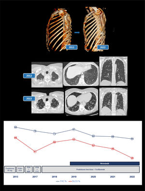 Radiological progression of the patient over a 10-year follow-up period. Serial high-resolution computed tomography (HRCT) scans demonstrate progressive upper lobe pleuroparenchymal fibroelastosis and development of fibrotic nonspecific interstitial pneumonia (NSIP) changes in the lower lobes, characterized by subpleural fibrosis, reticulation, and traction bronchiolectasis. In addition, flattening of the anterior thoracic cage with deep depression of the suprasternal notch is clearly evident. The lower graph shows the evolution of respiratory function expressed in terms of forced vital capacity (FVC) and diffusing capacity for carbon monoxide (DLCO) as percentages. In addition, a legend is included indicating the treatments the patient received at each point in time. PRD: prednisone. AZA: azathioprine. MMF: mycofenolate. CYC: cyclophosphamide.