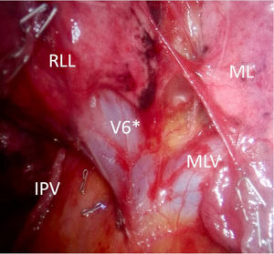 Intraoperative thoracoscopic view during right lower lobectomy showing an anomalous venous drainage pattern, with an independent trunk formed by the segment VI vein (V6, asterisk) and the middle lobe vein (MLV), draining directly into the left atrium. IPV: inferior pulmonary vein; RLL: right lower lobe; ML: middle lobe.