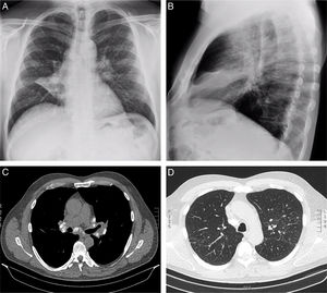 (A) Posteroanterior and (B) lateral chest radiographs showing bilateral reticulonodular opacities, hilar lymphadenopathy, and increased density with middle lobe atelectasis. (C) Chest CT scan in mediastinal window showing calcified mediastinal and hilar lymph nodes bilaterally. (D) Chest CT scan in lung window showing a bilateral micronodular interstitial pattern.
