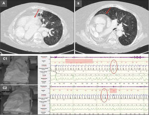 (A) Chest computed tomography demonstrating congenital dextrocardia (arrow). (B) Congenital pulmonary hypoplasia (arrow). (C1) NIV titration in the left lateral decubitus position showing ventilatory asynchronies and hypocapnia (oval). (C2) NIV titration in the right lateral decubitus position with resolution of asynchronies and improved oxygen saturation (oval).