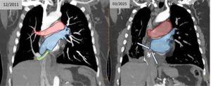 Contrast-enhanced chest CT scan demonstrating right pulmonary venous drainage correction through pericardial patch (first image) and its complete occlusion (second image). Red: left circulation; Blue: right circulation; Green: pericardial patch conduit connecting to the left atrium via the atrial septal defect.