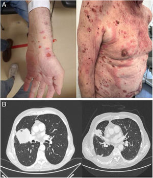 (A) Evolution of dermatological lesions between May (left) and September (right) of 2024. (B) Evolution of primary pulmonary lesion between March 2023 (left), before treatment, and February 2025 (right), 5 months wihout pembrolizumab.