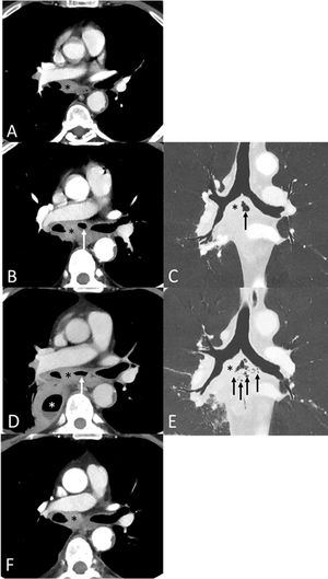 (A) Axial image (mediastinal window) from the baseline CT study shows an enlarged homogeneous subcarinal lymph node normal. (B and C) Axial (B, mediastinal window) and coronal (C, lung window) images from a follow-up CT study performed 8 weeks after initiation of chemo-immunotherapy shows enlargement of the subcarinal lymph node (asterisk) and the appearance of intranodal air (arrow); note the lack of communication of the intranodal air with the airway. (D and E) Axial (D, mediastinal window) and coronal (E, lung window) images from a CT study performed 4 weeks after B and C demonstrate further enlargement of the subcarinal lymph node (black asterisk) and the appearance of a loculated right pleural effusion (white asterisk) with an air-fluid level (hydropneumothorax); note the presence of more air bubbles within and surrounding the subcarinal lymph node (arrows). (F) Axial (mediastinal window) CT image from a study performed 4 weeks after D and E shows a decrease in the size of the subcarinal lymph node (asterisk), and disappearance of the right pleural effusion and of both the intranodal and perinodal air.