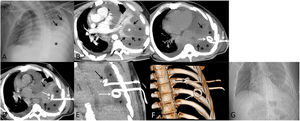 (A) Anteroposterior chest radiograph showing a left lower lobe consolidation (asterisk) and a moderate ipsilateral pleural effusion (arrows). (B) Axial thoracic contrast-enhanced CT image showing a left lower lobe lung abscess (white asterisk) and a large ipsilateral pleural effusion (black asterisks). Note the thin rim of lung parenchyma surrounding the lung abscess (arrows). (C) Axial thoracic unenhanced CT image showing the first pigtail catheter (white arrows) inserted within the left pleural cavity (asterisks), which allowed the approximation of the lung abscess to the chest wall. Note the left lower lobe consolidation (black arrows). (D) Axial thoracic unenhanced CT image showing the insertion of the 2nd pigtail catheter (white arrows) inside the partially collapsed left lower lobe with associated lung abscess (white asterisk). Note the left pleural effusion (black asterisks) and the left lower lobe consolidation (black arrows). (E) Coronal thoracic unenhanced maximum intensity projection CT image showing both the pleural pigtail catheter (white arrow) and the intrapulmonary pigtail catheter (black arrow). Note the partially collapsed left lower lobe with associated lung abscess (white asterisk) and the partly evacuated left pleural effusion (black asterisks). (F) Coronal 3D reconstruction CT image showing the 2 pigtail catheters: the pleural drainage catheter (white arrow) is less advanced than the intrapulmonary drainage catheter (black arrow). (G) Anteroposterior chest radiograph obtained 6 days after the double drainage procedure showing significant radiological improvement.
