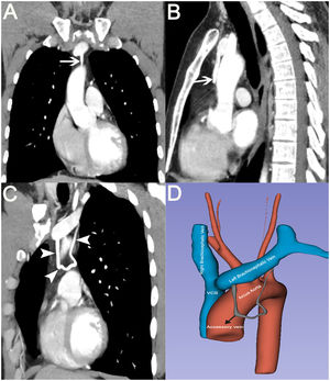 (A, B) Coronal and sagittal contrast-enhanced thoracic CT images showing an accessory vein originating from the left brachiocephalic vein and draining back into the same vein (arrows). (C) On the coronal maximum intensity projection (MIP) image, the entire course of the accessory vein is visualized (arrowheads). (D) Three-dimensional (3D) reconstruction image showing the normal vascular structures along with the accessory vein.