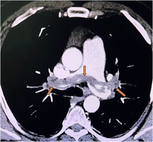 CT pulmonary angiography in a hemodynamically stable patient showing a bulky saddle embolus straddling the bifurcation of the main pulmonary artery and partially obstructing both main pulmonary arteries (red arrows) – an appearance traditionally associated with ‘massive’ or high-risk pulmonary embolism.