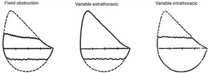 Flow–volume curve patterns suggestive of upper airway obstruction.