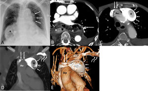 (A) Anteroposterior chest radiograph shows an abnormal left mediastinal contour (arrows). Note a large hiatal hernia (asterisk). (B) Axial thoracic CT image shows a non-occlusive filling defect involving a segmental pulmonary artery (arrow); note the large hiatal hernia (asterisks). (C) Axial thoracic CT image demonstrates a narrowed left innominate vein (long arrows) running between the sternum (St) and the ascending aorta (Ao), a saccular aneurysm of the left innominate vein (short arrows), and a large filling defect within the aneurysm (asterisk). (D) Coronal thoracic CT image shows the compressed left innominate vein (long straight arrows) by the ascending aorta (Ao) and the retrograde aneurysmal dilatation of the left innominate vein (short arrows); note the intra-aneurysmal thrombus (asterisk) and the normal-looking left subclavian vein (curved arrows). (E) 3D reconstruction CT image shows the stenotic left innominate vein (long straight arrows) compressed by the ascending aorta (Ao), the retrograde dilatation of the left innominate vein (short arrows), and the normal-looking left subclavian vein (curved arrows).