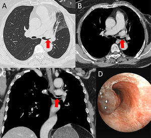 Unenhanced chest CT (A) revealed intraluminal neoplastic masses in the left main bronchus and left upper lobe bronchus (arrow), causing obstruction and atelectasis. Enhanced venous-phase images (B, C) demonstrated progressive and marked contrast enhancement of the masses (arrows). Bronchoscopy (D) revealed the presence of a smooth, purplish-red neoplasm inside the left main bronchus.