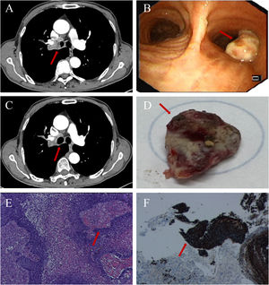 Thoracic CT section (A) showing obstruction of the right main bronchus (arrow). Flexible bronchoscopy (B) reveals an endobronchial neoplasm at the corresponding site (arrow). Follow-up thoracic CT (C) demonstrates restored patency of the previously obstructed bronchial lumen (arrow). Macroscopic view of the spontaneously expectorated tissue mass (D) (arrow). Histopathological examination (E) and immunohistochemical staining (F) confirm the diagnosis of squamous cell carcinoma (arrows).