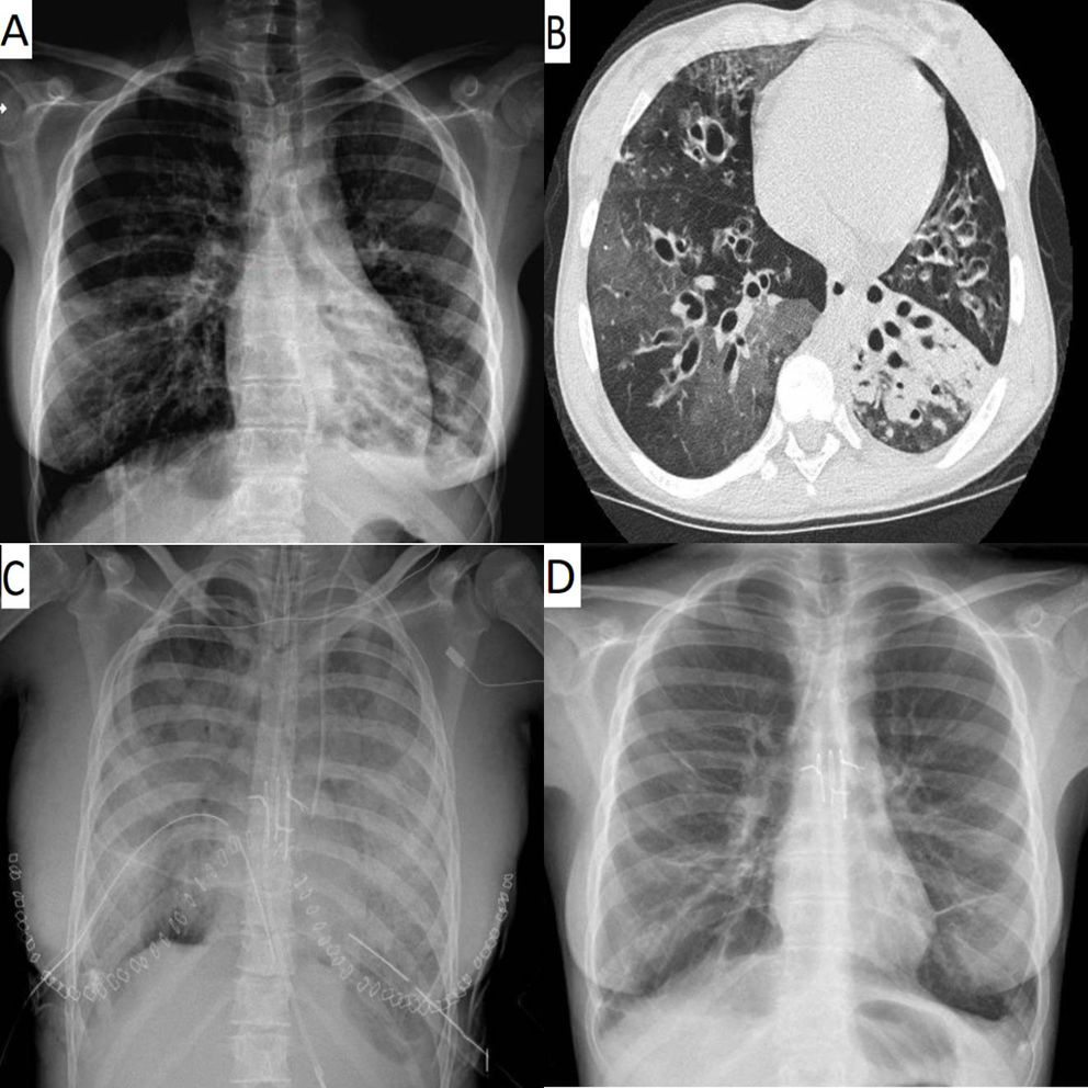 Lung Transplantation in a Rare Disease: A Novel Therapeutic Option for ...