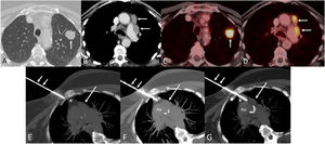 (A) Axial chest CT image (lung window) showing a solid nodule in the left upper lobe (arrow). (B) Axial CT image (mediastinal window) demonstrating enlarged lymph nodes in the prevascular and paraaortic stations of the ipsilateral mediastinum (arrows). (C and D) Axial fused PET/CT images showing intense FDG uptake in the left upper lobe nodule (C) and the ipsilateral mediastinal lymph nodes (D) (arrows). (E–G) Axial CT images demonstrating progressive transmediastinal needle insertion (short arrows) through the chest wall (E) and mediastinal fat pad (F) to reach the enlarged preaortic lymph node (large arrow, G). The asterisk denotes the transmediastinal trajectory. Note the right parasternal extrapulmonary approach and semilateral decubitus patient positioning to avoid aortic (Ao) puncture.