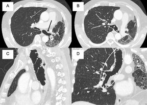 (A, B) CT scan showing formation of saccular dilations and tracheal pseudomembranes on the trachea and main bronchi (black and white arrows). (C) CT scan in a sagittal view showing affectation of the anterior and posterior walls of the trachea (white arrows). (D) MPR reconstruction of the trachea and right main bronchus showing an extensive mural disease (white ellipse).
