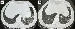 (A) Baseline CT scan demonstrating bilateral bronchiectasis in the middle lobe and lingula, accompanied by “tree-in-bud” pattern and endoluminal secretions, with associated volume loss. (B) Follow-up CT after six months of nebulized levofloxacin showing improvement and decreased “tree-in-bud” opacities.