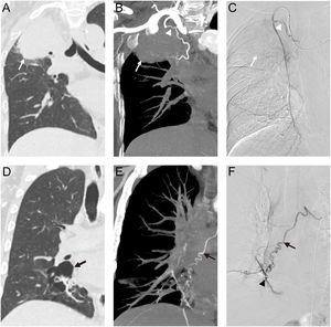Intraprocedural Angio-CT and confirmatory angiography in a 56-year-old woman with lung cancer-related massive hemoptysis: (A) coronal CT image (lung window) demonstrates a right upper lobe tumor (white arrow). (B) Coronal CT maximum intensity projection image (mediastinal window) reveals an ectopic bronchial artery (white arrowhead) arising from the right internal mammary artery, supplying the tumor (white arrow). (C) Selective angiography image of the right internal mammary artery confirms the culprit artery (white arrowhead) and tumor parenchymal staining (white arrow). Intraprocedural Angio-CT and confirmatory angiography in a 47-year-old man with bronchiectasis-related massive hemoptysis: (D) Coronal CT image (lung window) demonstrates cystic lesions (black arrow) in the right lower lobe. (E) Coronal CT maximum intensity projection image (mediastinal window) reveals a dilated tortuous bronchial artery branch (black arrow) supplying the lesion, with adjacent pulmonary vessel opacification (black arrowhead), indicative of systemic-pulmonary shunt formation. (F) Selective angiography image of the bronchial artery confirms the culprit hypertrophic branch (black arrow) and its direct communication with pulmonary vasculature (black arrowhead).