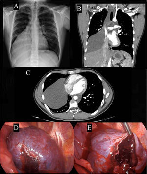 Posteroanterior chest radiography (A). Coronal and axial computed tomography (B and C). Mediastinal malformation filled with clots (D and E).