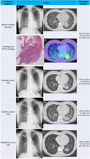 Patient clinical findings. Baseline radiography and CT revealed innumerable ring-shaped ground-glass nodules (GGNs) with two solid nodules in the left lower lobe (A, B). Transbronchial biopsy showed non-mucinous adenocarcinoma with a micropapillary pattern (C), and PET/CT demonstrated mild uptake (D). After one cycle of FLAURA2, GGNs and solid components improved (E, F), but progression occurred after three cycles (G, H). MARIPOSA therapy yielded marked improvement after five cycles (I, J). Laboratory trends are shown at right.