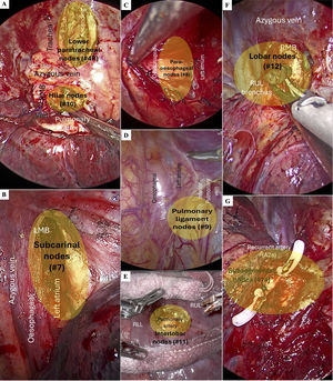 Endoscopic images of video-assisted thoracoscopic surgery (VATS) or robot-assisted thoracic surgery (RATS) with surgical anatomical landmarks of the right lymph node stations of the IASLC lymph node map [26]. (A) Stations #4R and #10, (B) Station #7, (C) Station #8, (D) Station #9, (E) Station #11, (F) Stations #12 and (G) Station #14. RMB: right main bronchus; RUL: right upper lobe; LMB: left main bronchus; RLL: right lower lobe.