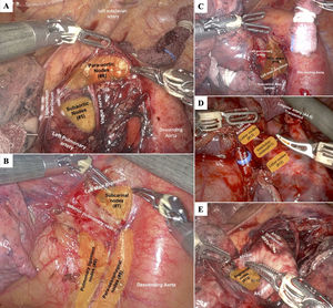 Endoscopic images of video-assisted thoracoscopic surgery (VATS) or robot-assisted thoracic surgery (RATS) with surgical anatomical landmarks of the left lymph node stations of the IASLC lymph node map [27]. (A) Stations #5 and #6, (B) Station #7, (C) Station #10, (D) Station #11 and #12, and (E) Station #13. LUL: left upper lobe.