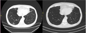 Chest computed tomography showing right lower lobe ground-glass opacities at diagnosis (left), with complete resolution of pulmonary lesions after treatment (right).