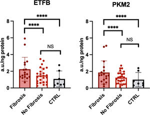 Comparison of ETFβ and PKM2 concentrations among patients who developed fibrotic changes at 1 year, those who did not, and controls. Comparisons were performed using the Student t test. Higher levels of both ETFβ and PKM2 were observed in patients with fibrosis compared with those without fibrotic changes and with controls. ETFβ indicates electron transfer flavoprotein β; PKM2, pyruvate kinase M2.