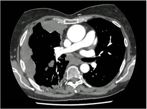 Preoperative chest CT scan (axial view) showing diffuse right pleural thickening with multiple enhancing nodules, consistent with pleural carcinomatosis.