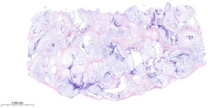 Histopathological findings. (A) Low-power view (hematoxylin–eosin stain, ×6.1) showing abundant extracellular mucin pools dissecting fibrous tissue, characteristic of pseudomyxoma peritonei.