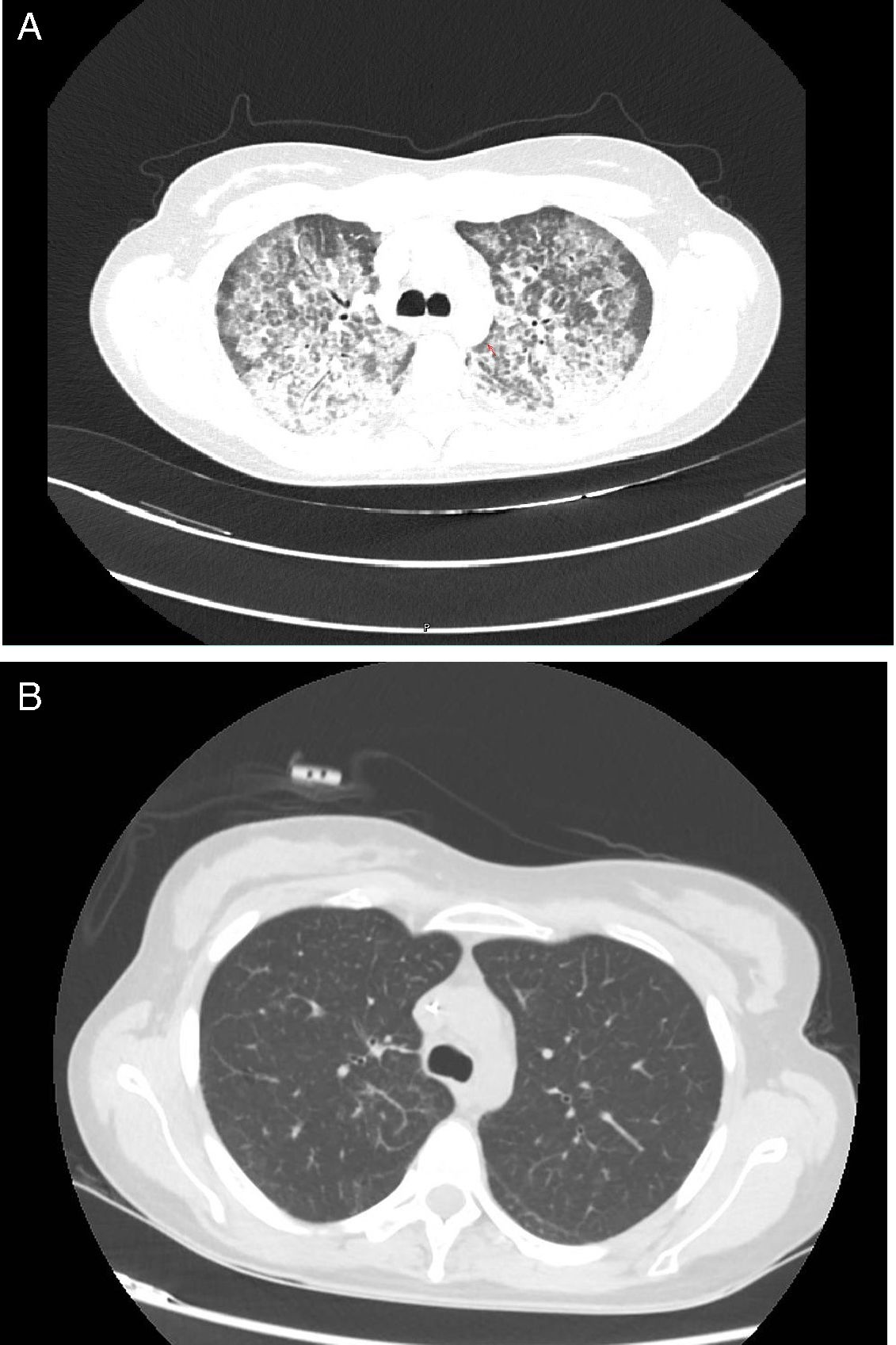 Secondary Pulmonary Alveolar Proteinosis Due to MonoMAC Syndrome ...