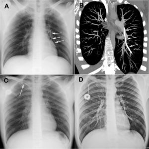 Posteroanterior chest radiograph (A) and coronal CT reconstruction (B) demonstrating a catheter fragment lodged in the left lower-lobe pulmonary artery (arrows). Posteroanterior chest radiograph (C) showing focal narrowing of the central venous catheter due to compression at the junction of the first rib and the ipsilateral clavicle, consistent with pinch-off syndrome (arrows). Posteroanterior chest radiograph (D) demonstrating catheter rupture, with the distal fragment projected over the region of the left lower-lobe pulmonary artery.