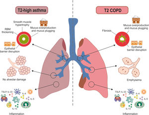 Comparison of type 2 (T2)-high asthma and T2-COPD. Left panel, T2-high asthma is characterized by RBM thickening, airway smooth muscle hypertrophy, epithelial barrier disruption, mucus overproduction, inflammation, and preserved alveolar architecture. Right panel, T2-COPD patients display epithelial barrier disruption, mucus overproduction, fibrosis, alveolar destruction (emphysema), and inflammation. COPD, chronic obstructive pulmonary disease; RBM, reticular basement membrane; T2, type 2.