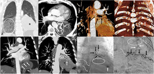 (A) Coronal minimum intensity projection (minIP) CT image (lung window) shows a large area of ground-glass attenuation in the right lower lobe, consistent with hemorrhage. Note a large mass in the left hemithorax (asterisk). (B) Axial maximum intensity projection (MIP) CT image (mediastinal window) shows the radiopaque filament (ellipse) of the retained foreign object (a surgical gauze). (C and D) Coronal 3D reconstruction CT images show a hypertrophic left bronchial artery (black arrows) and tortuous intercostal arteries (white arrows). (E) Coronal MIP CT image demonstrated an enlarged left phrenic artery (arrows). (F) Coronal MIP CT image (mediastinal window) shows a focus of contrast extravasation (arrow), consistent with active bleeding; note the radiopaque filament of the retained surgical gauze (ellipse). (G and H) Angiography of the left bronchial (G) and intercostal (H) arteries show hypertrophic arteries (black arrows). Note the presence of a contrast blush in G (white arrow) indicating active bleeding, and the opacification of left lower lobe pulmonary arteries in H (white arrows) indicating the formation of systemic-to-pulmonary artery fistulas. Also note the radiopaque marker of the gossypiboma (ellipse) and the vascular catheters (curved arrows).