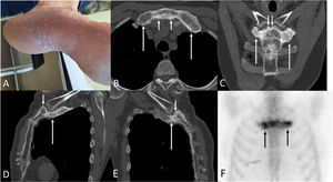 (A) Picture shows pustules and thick scales involving the sole of the left foot. (B, C) Axial (B) and coronal (C) low-dose chest CT images (bone window) show hyperostosis and ankylosis of the first chondrosternal joints (long arrows) as well as osteosclerosis and cortical irregularity of the manubrium (short arrows). (D, E) Sagittal oblique chest CT images show the first chondrosternal joints (D corresponds to the right joint whereas E corresponds to the left one); note the hyperostosis of both chondrosternal joints (long arrows), the cortical irregularity of the manubrium (short arrows), and the minimal involvement of the sternoclavicular joints. (F) Bone scintigraphy of the thorax (anterior view) shows intense radiotracer uptake by the first chondrosternal joints and upper manubrium (arrows).
